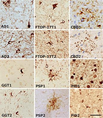 Comparison of Common and Disease-Specific Post-translational Modifications of Pathological Tau Associated With a Wide Range of Tauopathies